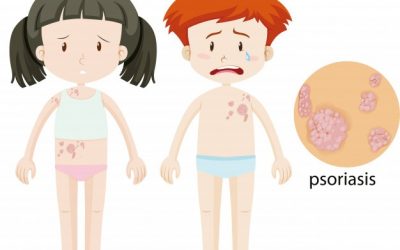 Efectos positivos del cannabis en el tratamiento de la psoriasis