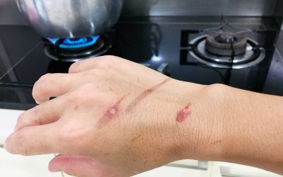 Tratamiento de quemaduras con cannabis