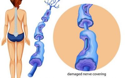 5 beneficios del cannabis para la Esclerosis Múltiple