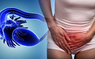 CBD para el síndrome de ovarios poliquísticos (SOP)