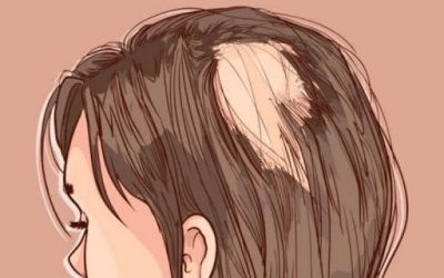 Aceite de cannabis para la alopecia