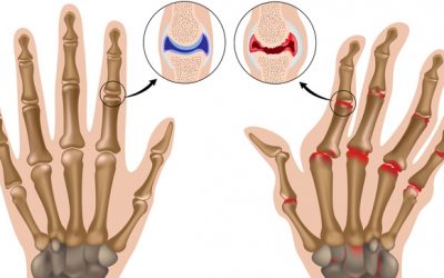 Tratamiento de la artritis con cannabis