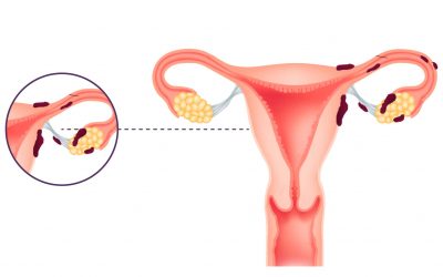 Cannabis y endometriosis