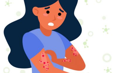Cannabis para aliviar el efecto de la dermatitis