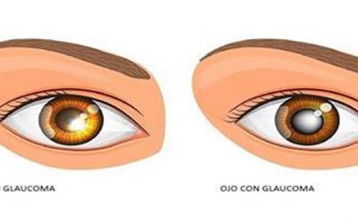 Una alternativa para el tratamiento del glaucoma