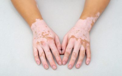Tratamiento de vitiligo con cannabis