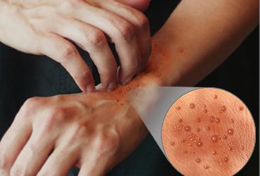 Beneficios del cannabis para la dermatitis atópica