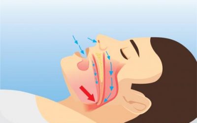 Apnea del sueño: ¿Puede el THC ser útil en el tratamiento?
