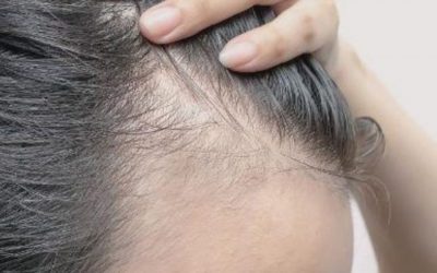 El cannabis podría detener la caída del pelo y combatir la calvicie