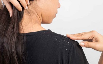 Cannabis para combatir la caspa