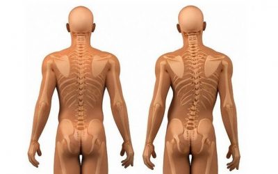 Cannabis medicinal, ¿alternativa para el tratamiento de la escoliosis dorsolumbar?