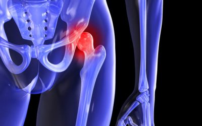 Cómo ayuda el aceite de cannabis al dolor de cadera relacionado con la bursitis