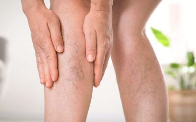 ¿Es el aceite de cannabis puede aliviar síntomas de la trombosis venosa profunda?